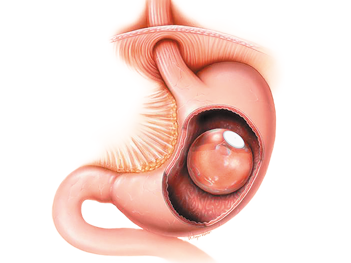 Intragastric balloons procedure 