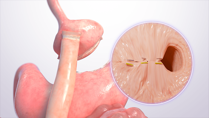 TORe procedure 