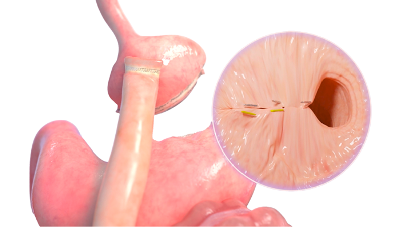Intragastric balloons procedure